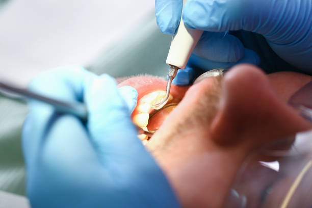 Best Emergency Treatment for Dental Infections or Abscesses in Elizabethton, TN
