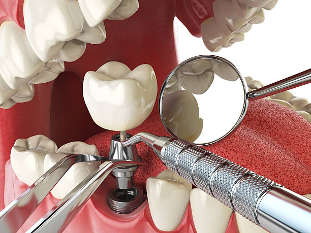 Best Emergency Wisdom Teeth Removal in Elizabethton, TN